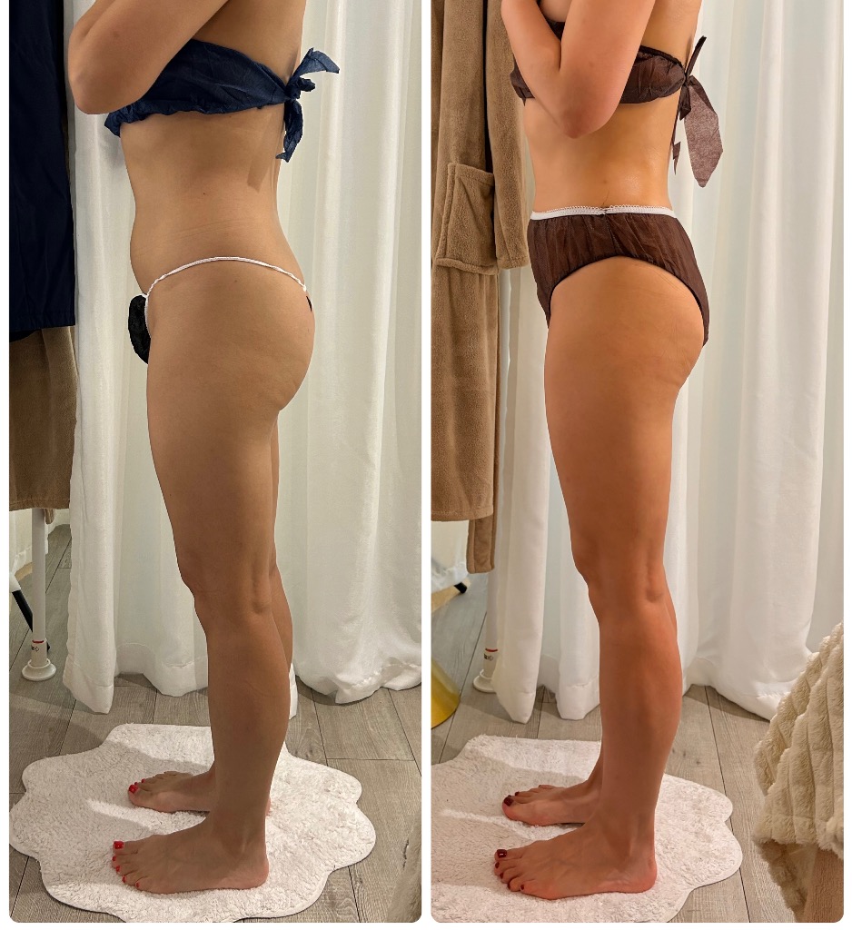 お尻が1cm下がると起こること